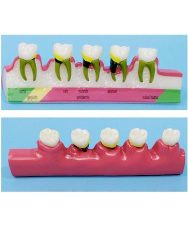 Dytah Dental Model - Adult Teeth Lessons for Periodontitis & Dental Disease Classification | Ideal for Teaching & Study - Buy Online on GoSupps.com