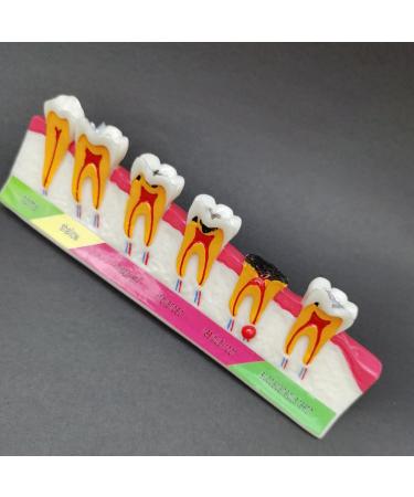 LEYTON Tooth Model for Dental Teaching | Caries Model Enhance Understanding of Pathological Processes | International Shipping Available - Buy Online on GoSupps.com