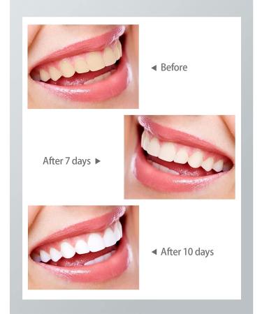 NC JYT DCS Teeth Whitening Kit with 16 LED Lights - Home Dental Brightening System with 3 Gel Pens - Black - Buy Online on GoSupps.com