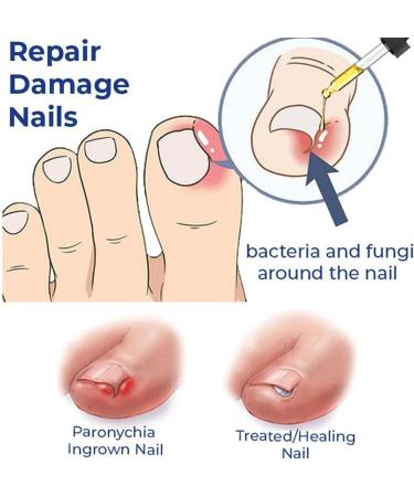 Huile de paronychia allemande pour enlever la paronychia traitement des ongles des pieds meilleure solution de r paration des ongles liquide de renouvellement des ongles endommag s (3 pi ces) 3 pi ces. - Buy Online on GoSupps.com