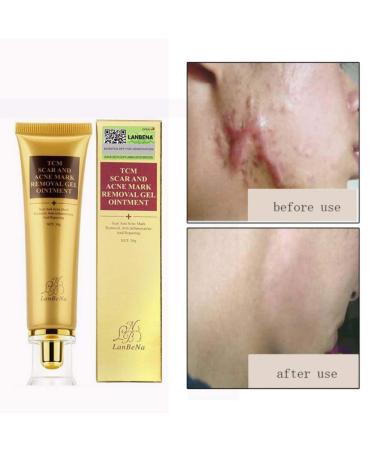 Symeas Scar & Acne Removal Cream - Effective Treatment for Stretch Marks Keloid Skin & Burns - 30g - Buy Online on GoSupps.com