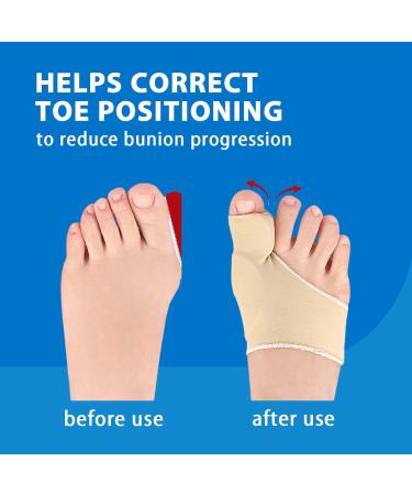 Diosky Bunion Relief & Toe Corrector - 2 Pairs Hallux Valgus Fix Pads for Men & Women - Big Toe Straightener - Beige Size: Women 7-9 & Men 5-8 - Buy Online on GoSupps.com