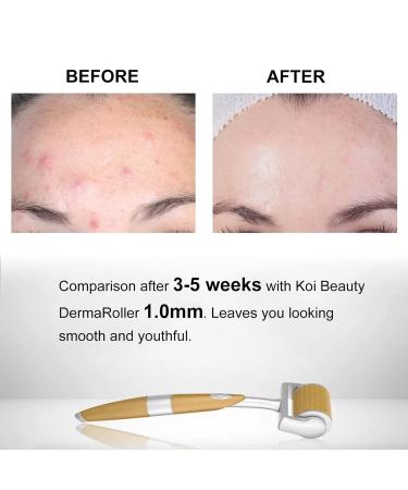 Koi Beauty Dermaroller 1mm - 192 Real Needles for Hair & Beard Growth | Microneedling Tool for Men & Women | Achieve Results at Home - Buy Online on GoSupps.com