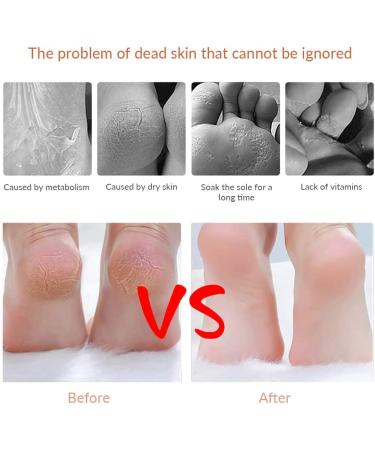 Codream Pedicure Callus Shaver with 10 Replacement Blades and Case - Buy Online on GoSupps.com