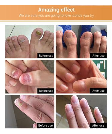 Maximum Strength Nail Fungus Repair Treatment - Natural Formula for Toenail and Fingernail Repair - Buy Online on GoSupps.com