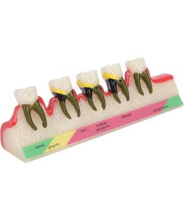 Shop Verdant Touch Tooth Model - Dental Periodontal Disease Study Tool for Schools | International Shipping Available - Buy Online on GoSupps.com