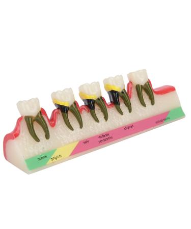 Model for dental periodontitis dental periodontal development model tooth disease study learning model for dental studies and research