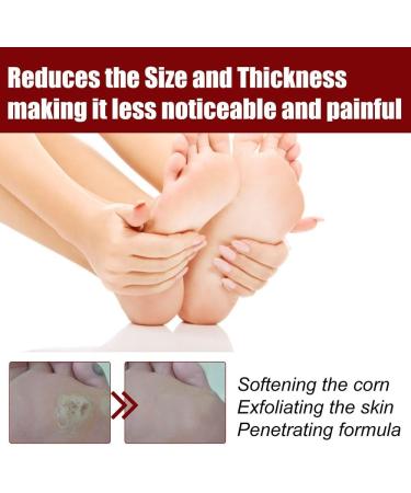 Hsadav GFOUK Foot Corn Removal Gel | Extra Strength 10ml Cream for Feet | Corn Removers (2pcs) - Buy Online on GoSupps.com