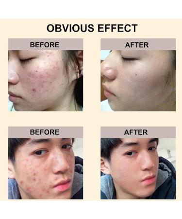 Chinese Herbal Acne Treatment Cream Natural Extract Acne & Spot Treatment for Face Acne Cream & Spot Cream for Face Pimple Cream for All Skin Types Smooth Gentle Acne Repair Oil Control - Buy Online on GoSupps.com