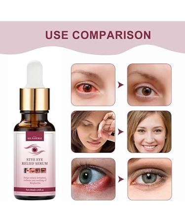 Eye Stye Remover for Fast Relief - Gentle Treatment for Styes  Chalazion  and Blepharitis - Buy Online on GoSupps.com