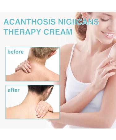 MINGRUO Dark Spot Removal Cream Dark Spot Correction Acanthosis Nigricans Therapy Cream for Dark Skin - Buy Online on GoSupps.com