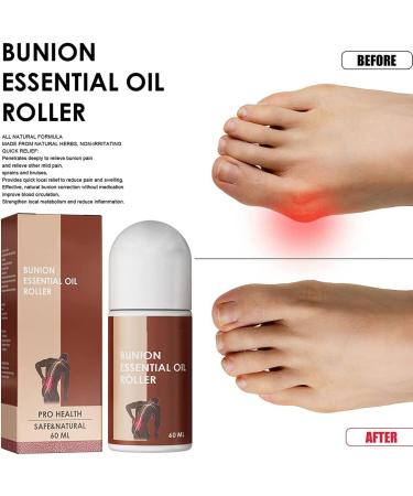 AAOCLO 2pcs Anti Bunion Treatment Oil Pain Relief Roller - Foot Care Corrector for Women & Men - Pro Health Solution - Buy Online on GoSupps.com