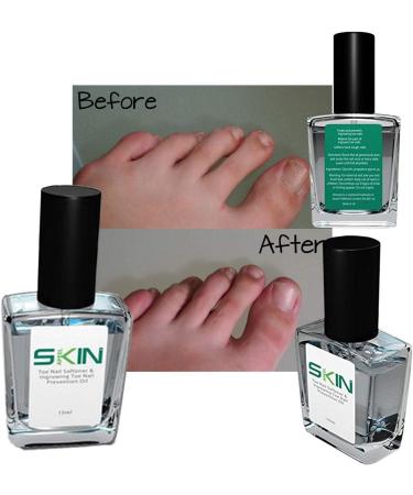Skinapeel Toe Nail Softener and Ingrown Toenail Treatment Oil - Solution for Hard Thick Cracked Nails - Buy Online on GoSupps.com