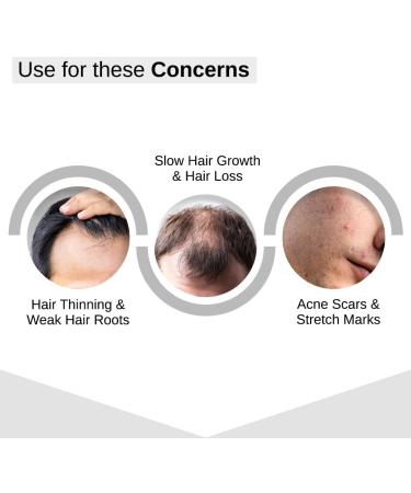 Bare Anatomy Derma Roller pour la pousse des cheveux | 0 25 mm avec 540 micro-aiguilles en titane | Stimule les follicules pileux et am liore la circulation du cuir chevelu - Buy Online on GoSupps.com