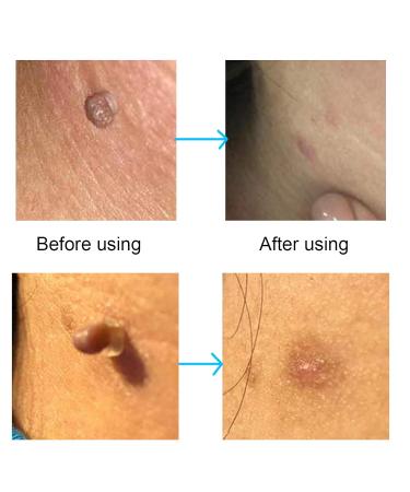 30 Pieces Skin Day Distant Rubber Bands | Fast & Safe Wart Removal | Non-Toxic Skin Care Tools - Buy Online on GoSupps.com