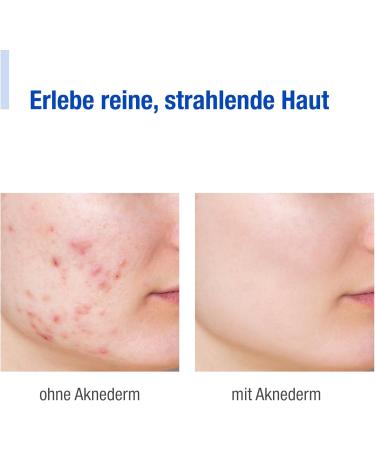  AKNEDERM Aknederm Lotion F 30 ml - Buy Online on GoSupps.com
