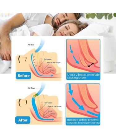 Snore Stopper Magnetic Nose Clip - 6 Pack for Better Sleep | Anti-Snoring Clip - Buy Online on GoSupps.com
