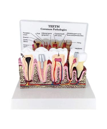 Anatomical torso and skeletal models 4 x 4 teeth anatomi models frequent pathologies combination models removable tooth for oral care education and lower