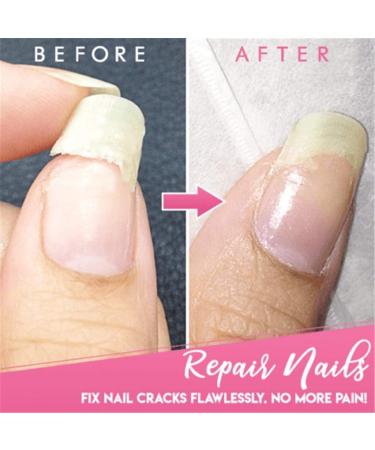 5ml Instant Cracked Nail Repair Gel - Nail Strengthener & Phototherapy Glue - Restore Weak, Broken, & Damaged Nails - Fast Fix for Nail Cracks - 1pc - Buy Online on GoSupps.com