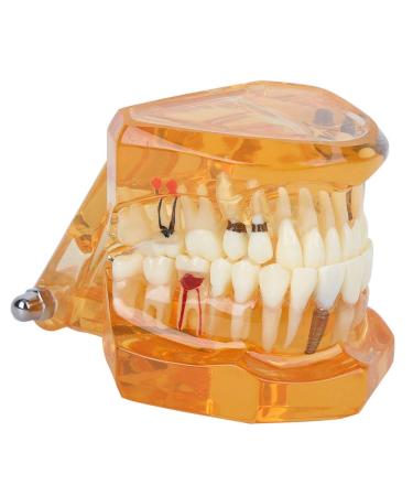 Standard Tooth Model - Removable Dental Teaching Materials for Kids & Adults | Typodont Demonstration Model - Buy Online on GoSupps.com