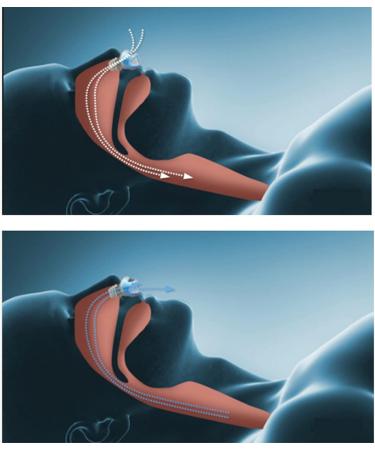 Portable Anti-Snoring Device - Electric Solution for Heavy Snorers | Shockproof Design & Air Purifier - Reduce Snoring (Blue - Buy Online on GoSupps.com