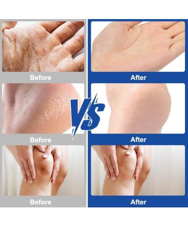 UNCLE 2 pieces moisturizing and anticracking foot cream 60 urea moisturizing and anticracking foot cream foot care cream relieves extreme dryness and cracking of the feet foot cream - Buy Online on GoSupps.com