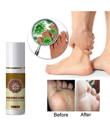 Fungal Combat Feet Spray- 3 Pcs Anti-Fungal Infections Athlete's Foot Herbal Peeling Spray 60ml - Buy Online on GoSupps.com