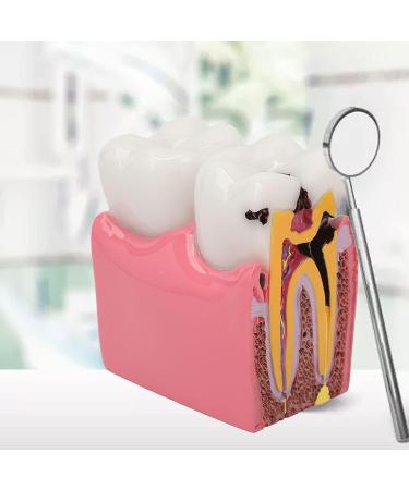 Tooth Caries Model - 6x Enlarged Caries Demonstration for Dental Education | International Shipping - Buy Online on GoSupps.com