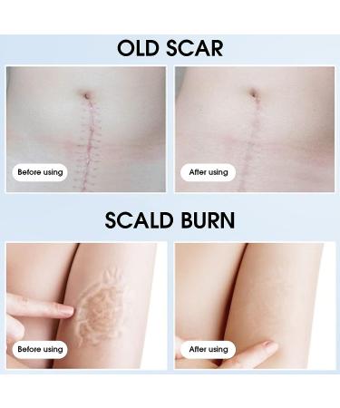 Scar Repair Cream 30G - Stretch Marks & Burn Marks Removal Ointment - Buy Online on GoSupps.com
