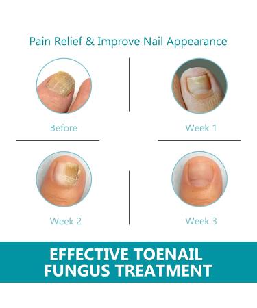 32Pcs Nail Repair Patches - Extra Strength Toenail Fungus Treatment for Damaged Nails - Buy Online on GoSupps.com