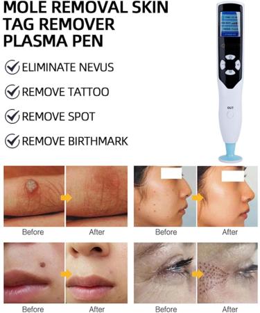  HDaspijh Ozone Fibroblast Plasma Pen for Face Lifting Wrinkle Removal Freckle and Mole Removal Eyelid Lifting 8 Energy Levels 7 Replacement Heads LCD Screen - Buy Online on GoSupps.com