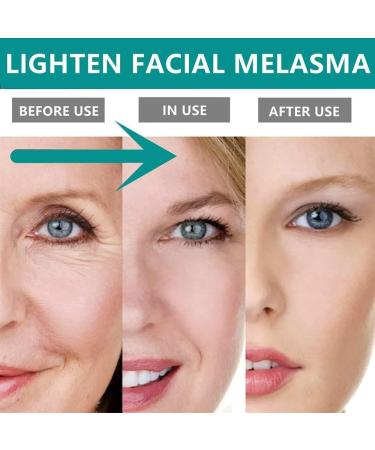Cr me pour le visage Melasma Taches de rousseur Cr me r novatrice pour la peau fonc e Cr me cosm tique pour le visage peau noire Yunnan Japanese Melasma Cream For All Skin Types (1pcs) - Buy Online on GoSupps.com