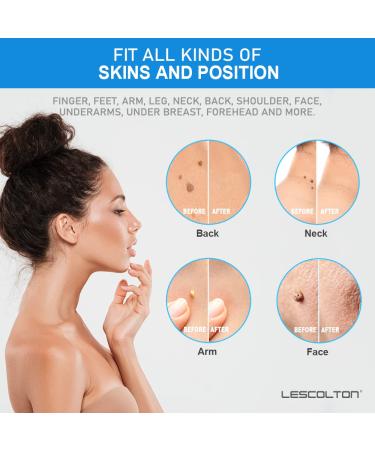 Skin Day Remover Kit - 40 Ligaments & 36 Repair Patches for Small to Medium Skin Tags - Buy Online on GoSupps.com