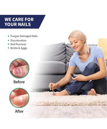 Nail Fungus Treatment - Toenail Fungus Repair Solution - Use at Home (1 Fl Oz) - Buy Online on GoSupps.com