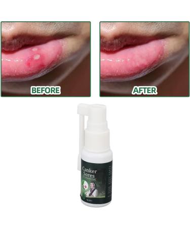20ml Canker Sore Relief Spray | Fast-Acting Mouth Ulcer Treatment - Buy Online on GoSupps.com