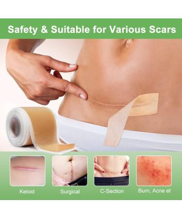 Scar Away Silicone Scar Sheets 1.8 x157 -4M - Medical Grade Tape for Surgical Incisions, C-Section, Keloid, Acne - Painless Scar Removal & Healing Strips - Buy Online on GoSupps.com