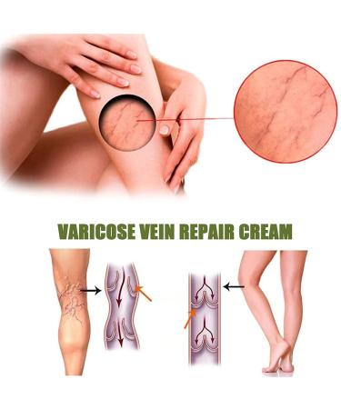 Buy Varicose Vein Treatment Soap - Ginger Infused Wood Soap for Smooth Skin (1 Piece) - International Shipping Available - Buy Online on GoSupps.com