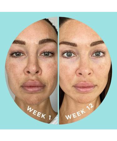 ZitSticka Blur Potion: Vitamin Supplement for Hyperpigmentation, Melasma & Dark Spots - 30 Caps - Buy Online on GoSupps.com