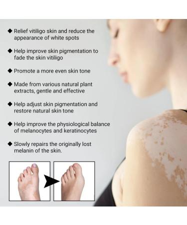 Vitiligo Removal Relief Spray - Reduces White Spots on Skin - 3pcs - Buy Online on GoSupps.com