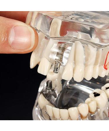ERNZI Dental Implant Disease Model with Restoration Bridge - Ideal for Dental Research & Education - Buy Online on GoSupps.com