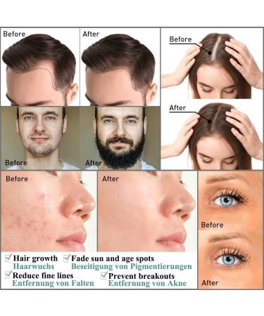 Zemolo Dermaroller 0.5mm - Microneedling Roller for Hair Care Face & Body | 540 Needles | Black Derma Scooter for Men & Women - Reduce Stretch Marks & Large Pores - Buy Online on GoSupps.com