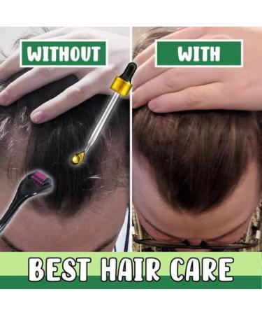 Hair Growth Oil Strong Hair Regrowth Serum Organic Hair Regrowth Kit Ginger Germinal Oil For Thicker Stronger Healthier Hair - Buy Online on GoSupps.com