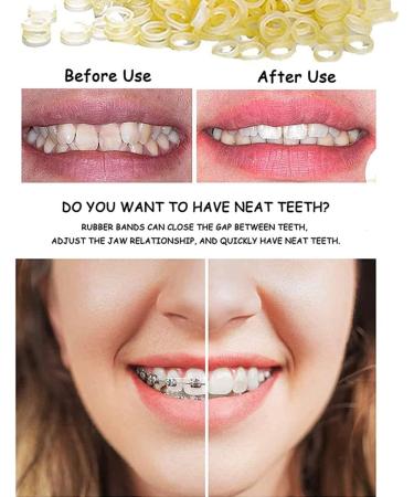 Elastic Teeth Rubber Bands (300 Pieces) & Orthodontic Wax (3 Pieces) for Braces Relief - Streak Dental Wax for Pain & Irritation - Buy Online on GoSupps.com