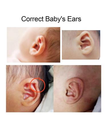 Baby Ear Aesthetic Corrector - Protruding Ear Patch Stickers - Buy Online on GoSupps.com