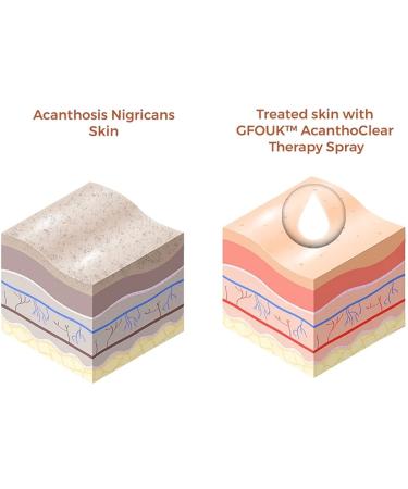 GFOUK Acanthoclear Therapy Spray - Dark Spot Corrector for Black Skin (1PCS) - Buy Online on GoSupps.com