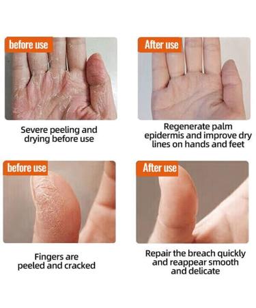Yutingchby Natural Winter Anti-Cracking Frost - 100% Natural Moisturizing Foot Cream for Rough Dry and Cracked Hands - Buy Online on GoSupps.com
