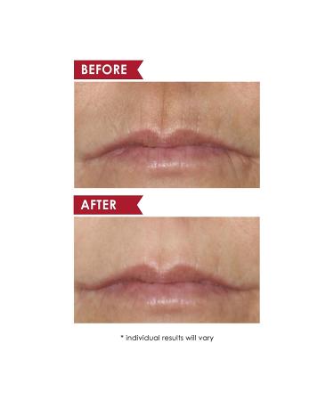 Dermelect Smooth Upper Lip Professional - Anti-Aging Cream with Hyaluronic Acid, Collagen, Retinol - 0.5 oz - Brightening & Smoothing Treatment for Lip & Smile Lines, Discoloration, Lipstick Bleeding - Buy Online on GoSupps.com