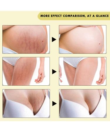 Natural Rose Stretch Mark Cream for Pregnancy - Effective Scar Removal & Prevention | 40g Body Moisturizer - Buy Online on GoSupps.com