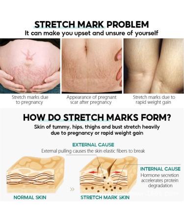 Stretch Mark Removal Acne Scar Stretch Fat Striae Gravidarum Treatment Repair Anti-Aging Angles Firming Body Care (2 Pack) - Buy Online on GoSupps.com