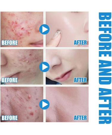 3pcs Micro infusion system for face Micro Infusion System for Lips Micro Infusion Facial System Smooth Skin Facial Serum for All Skin Types - Buy Online on GoSupps.com